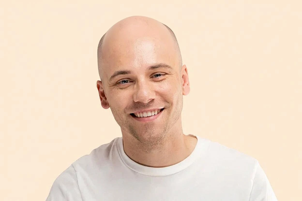 Natural Bald Results - After